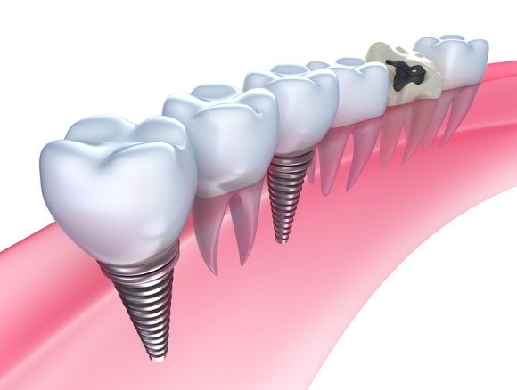 Dental Implants Glenview