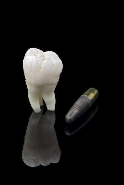 Glenview Dental Implants